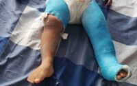 toddler-suffers-broken-leg-while-at-day-care
