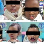 Nine successful cleft surgeries performed independently at GPHC