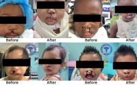 nine-successful-cleft-surgeries-performed-independently-at-gphc