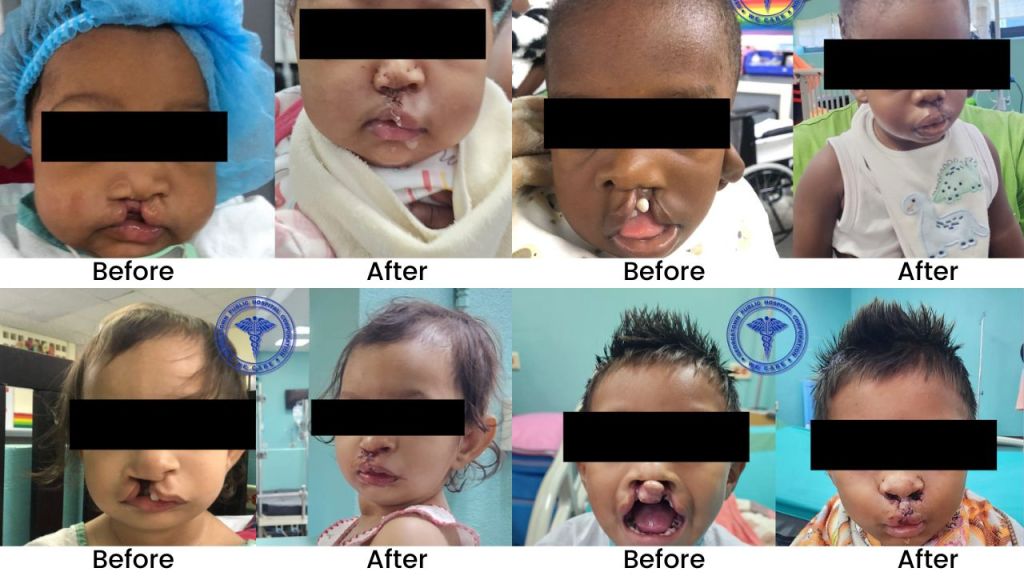 Nine successful cleft surgeries performed independently at GPHC